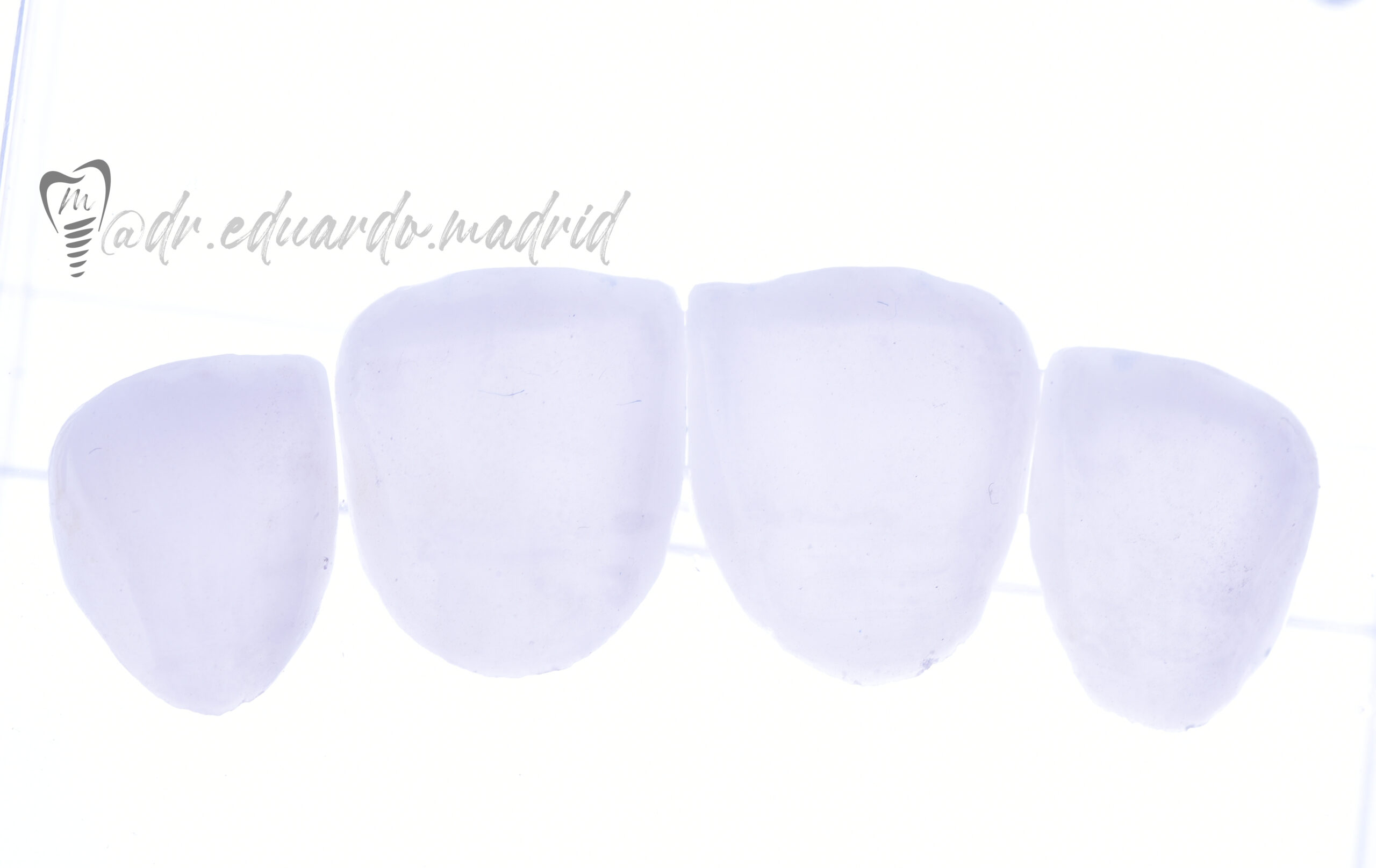 Veneers New smile in days Dental M&M Nogales