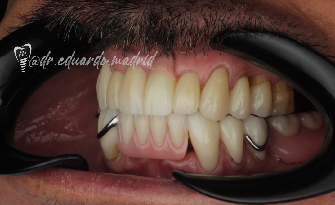Final intraoral lateral
